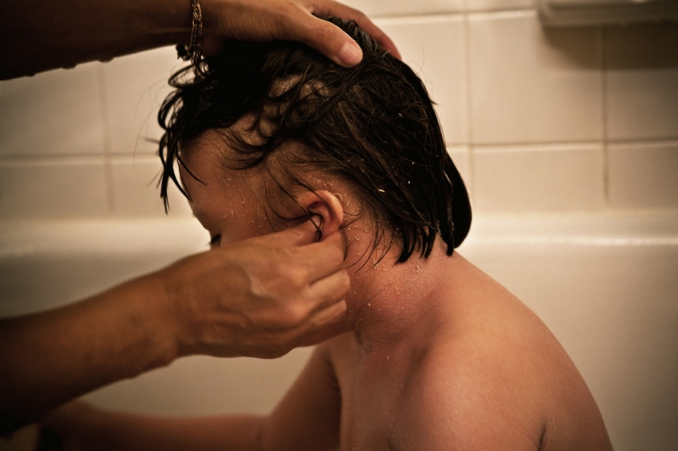 孤兒?。呼~鱗病女孩的艱難生活【圖】